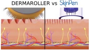 The Pitfalls Of DIY Micro-Needling: Why At-Home Derma-Rolling Can Be Dangerous