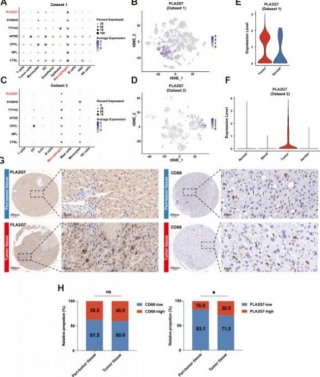 PLA2G7-A New Breakthrough In Reversing The Immunosuppressive Microenvironment Of Liver Cancer