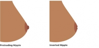What Causes Inverted Nipples: Understanding The Condition