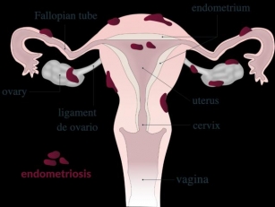 Understanding Endometriosis: A Comprehensive Overview