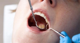 Placa Dental. ¿Qué Es? Causas, Prevención Y Riesgos