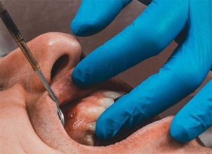 Fístula Dental Tratamiento Consecuencias.