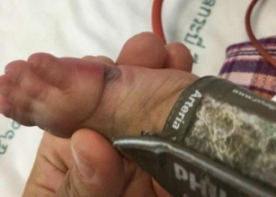 Six Month Old Thai Baby’s Foot Swollen Due To Tight Pulse Band