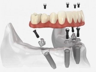 From Single Tooth Replacements To Full-Arch All-on-4 Solutions