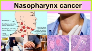 Nasopharyngeal Cancer: Symptoms, Causes & Treatment