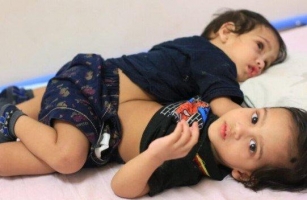 They Had One Liver, One Bladder, And One Stomach For Two”: Photos Of The Siamese Twins From India After Surgery!