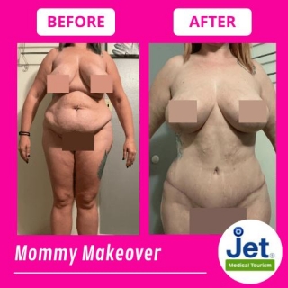 What Is Mommy Makeover