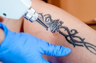 Eradicating Ink: Exploring Laser Tattoo Removal In Singapore