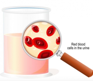 Causes Of Red Blood Cells In Urine