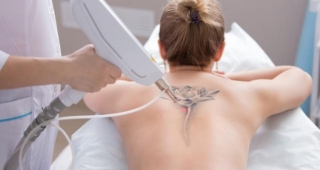 12 Important Facts About Laser Tattoo Removal