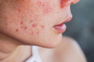 Acne Awareness: Prevention, Treatment, And Myths