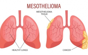 What is the Outlook for a Mesothelioma Diagnosis?