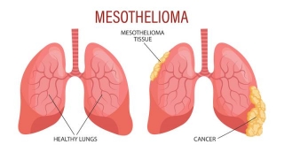 What Is The Outlook For A Mesothelioma Diagnosis?
