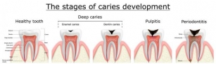 Meet The Best Root Canal Specialist In Noida And Delhi NCR