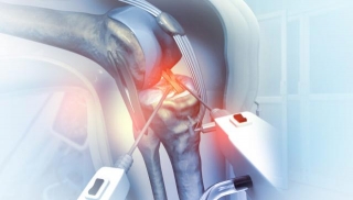 Knee Replacement Surgery 101: 10 Things To Consider