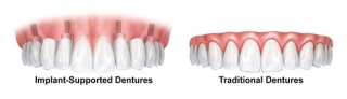 The Benefits Of Getting Dentures For The Restoration Of Teeth