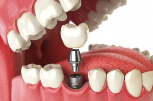 How Dental Implants Can Restore Your Smile And Confidence
