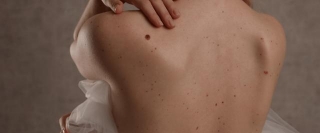The Cost Of Removing Skin Tags: Procedure, Benefits & Everything In-between!