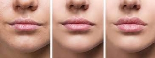 Discover The Magic Of Juvederm Lip Augmentation: A Guide To Fuller Lips
