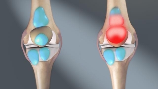Meniscal Cyst | Symptoms, Causes And Treatment