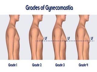 Understanding The Recovery Timeline After Gynecomastia Surgery