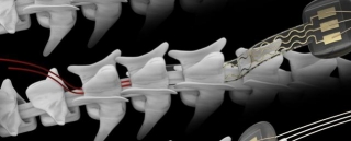 Understanding Radial Head Resection Implants: A Comprehensive Guide