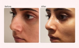 What Not To Do After Rhinoplasty?