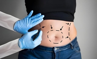 How Long Does It Take To Heal From Liposuction Surgery?