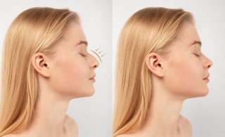 What Is The Success Rate Of Rhinoplasty?