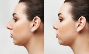 How Long To Recover From Rhinoplasty?