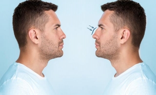 How Long Do You Have To Wait For Revision Rhinoplasty?