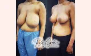 Common Problems After Breast Reduction Surgery