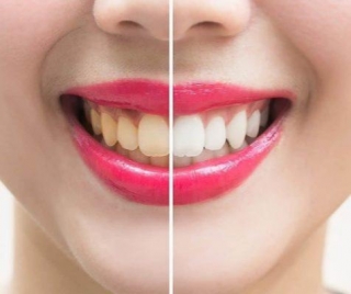 Teeth Whitening Secrets To A More Sexy You