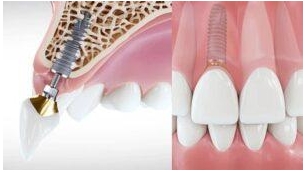 The Latest Advances In Dental Implant Technology