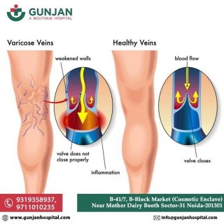Suffering From Varicose Veins Problem?