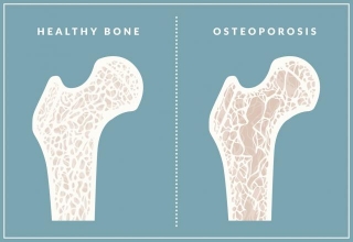 Avoid Osteoporosis With These 7 Dairy-Free Calcium Boosters