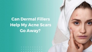 Can Dermal Fillers Help My Acne Scars Go Away?