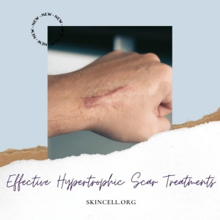 Effective Hypertrophic Scar Treatments