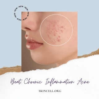 Beat Chronic Inflammation Acne