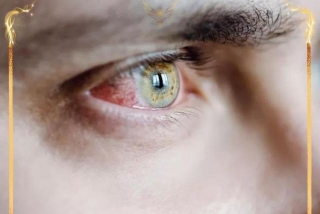 What Is Eye Syphilis? The Severe Symptom Doctors Are Seeing Amid The STD Epidemic