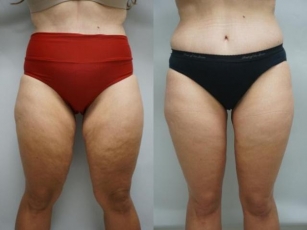 Considering A Thigh Lift? Here's What You Need To Know