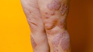 Skin Conditions Linked To Varicose Veins