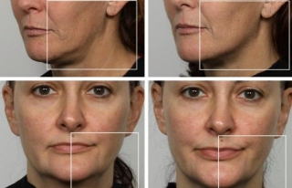 Nadove Micro Glow Facial Reviews: Does It Really Work?