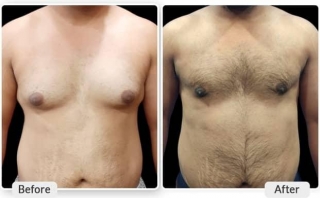 The Transformative Effects Of Gynecomastia Surgery