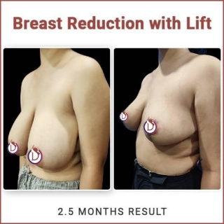 Comprehensive Guide To Breast Reduction