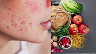 Foods That Can Trigger Skin Allergies
