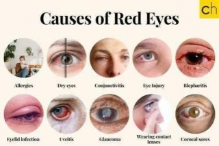 How To Get Rid Of Red Eyes