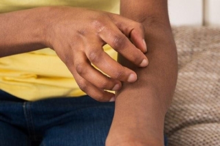 Itchy Skin (pruritus) - Symptoms And Causes -isa Adisa