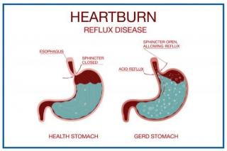Heartburn: Causes, Symptoms, Prevention, Treatment | Medicover