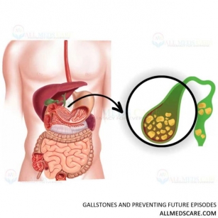 Naturally Cure Gallstones And Prevent Future Episodes
